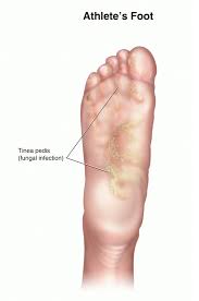 Uhs Health Topic Athletes Foot