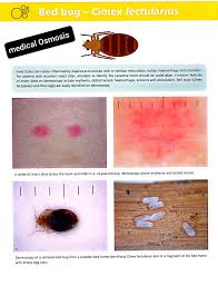 Image result for Cimex lectularius bites