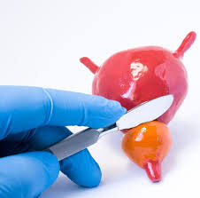 Wechseln sie jetzt auf einen aktuellen browser, um schneller und sicherer zu surfen. Adenom Prostatic Cauze Simptome Tratament