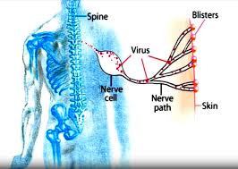 Image result for shingles