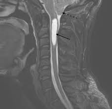 Image result for Syringomyelia