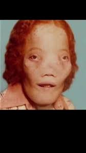 Rare Disease Conditions: The Stories of Rocky Dennis and Ella Harper