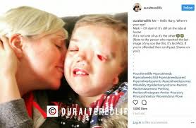 Disabled boy's picture pulled from Instagram after being reported over  facial deformity