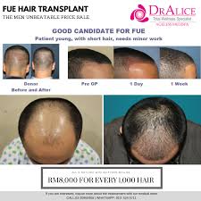 Saba rais for 6 years. Dr Ranjit Skin Specialist Hair Loss