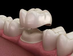 Let's start by explaining what a dental crown is. Cost Of Dental Crowns With Without Insurance Byte