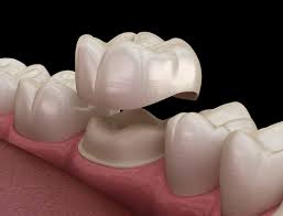 How much does the dentist cost without insurance. Cost Of Dental Crowns With Without Insurance Byte