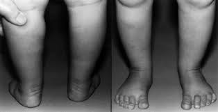 What is the meaning of club foot? To Parents Of Children Born With Clubfeet University Of Iowa Stead Family Children S Hospital
