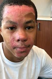 Report: Georgia teacher botched experiment, caused student's injury