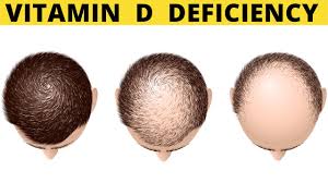A global perspective // mayo clinic proceedings. Symptoms Of Vitamin D Deficiency Depression Hair Loss Silva Guide Youtube