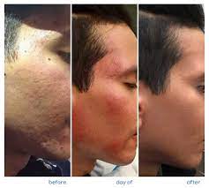 Maybe you would like to learn more about one of these? Microneedling The Dermatology Specialists