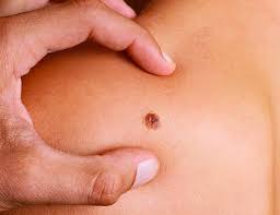 Because melanoma can be so dangerous once it advances, follow your instincts and visit your doctor if you see a spot that. More About Skin Cancer Myclinic