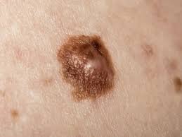 Boutons rouges qui grattent sur la peau. Causes Possibles D Une Bosse A L Arriere De La Racine Des Cheveux