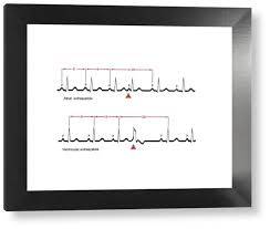 Image result for Extrasystole