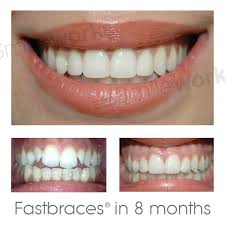 Beautiful Before And After With Fastbraces Brace Treatment Here At Smileworks Braces Treatment Perfect Teeth Teeth Braces