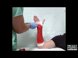 Image result for Short Arm Cast