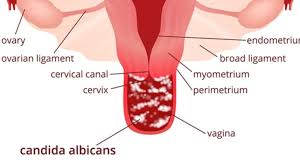 3 knowing the risk factors. Vaginal Yeast Infections Epicuriousmorsels Com