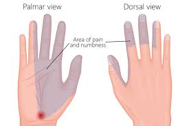 Read more about the symptoms, causes, and treatment of carpal carpal tunnel syndrome is not the only condition that can cause numbness and tingling in the hands and wrists. What Is Carpal Tunnel Syndrome Ultrasound Guided Injections