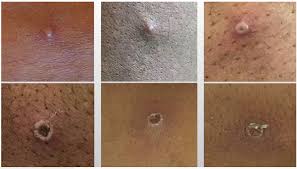 Image result for Monkeypox