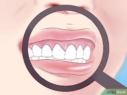 Cancer of the mouth and throat includes the lips, cheeks, neck, and tongue. How To Tell If You Have Mouth Cancer 15 Steps With Pictures