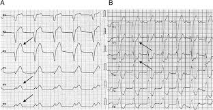 Image result for Left Bundle Branch Block