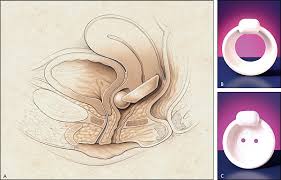General discussion post any comments, remarks, ideas, observations, experiences, concerns or questions here. Urinary Incontinence In Women Evaluation And Management American Family Physician