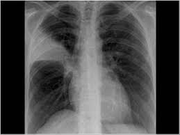Image result for Air Bronchogram