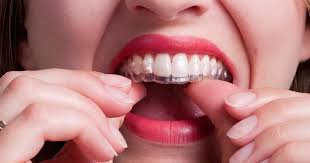 If the trays are not cleaned properly the bacteria can colonize. How To Clean My Retainer With Hydrogen Peroxide Arxiusarquitectura