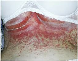 People with intertrigo tend to have irritated red skin in the skin folds. Candidal Intertrigo Consultant360