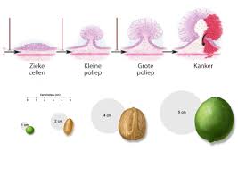 Dat is vooral het geval bij kankers van het rechtercolon en het colon transversum. Darmkanker Wat Zijn De Symptomen En Kun Je Het Voorkomen Libelle