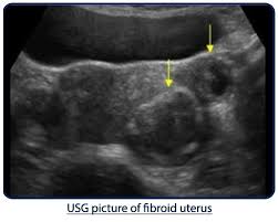 How to prevent fibroids from growing during pregnancy. What Are Fibroids