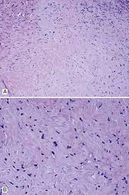 Biphasic mesothelioma epithelioid mesothelioma desmoplastic mesothelioma sarcomatoid mesothelioma. Desmoplastic Malignant Mesothelioma Thoracic Pathology A Volume In The High Yield Pathology Series Expert Consult Online And Print 1st Edition