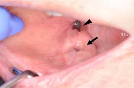 With today's modern procedures and follow up care, most extractions are safe and straightforward. Delayed Healing Of Tooth Extraction Sockets With Ramucirumab Use