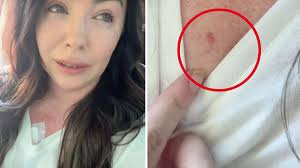Queensland mum was worried about stubborn spot