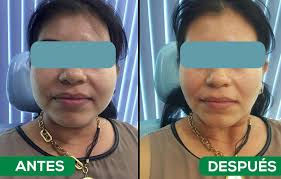 La bichectomía es uno de los secretos de las. Bichectomia Archives La Voz De Tarija