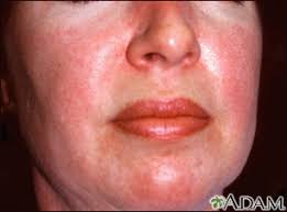 Image result for Dermatomyositis