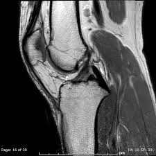 Grade iii tears (ligament rupture) are complete tears (the acl has been split in two). Medial Collateral Ligament Injury Grade 1 Radiology Case Radiopaedia Org