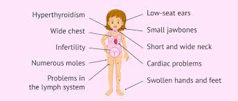 Turner Syndrome Causes Characteristics And Pregnancy