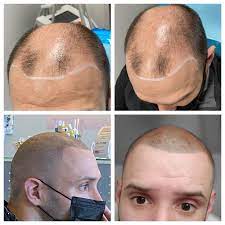 It can start at the hairline and 21. Hair Tattooing Twin Cities Scalp Micropigmentation Medical Tattoo Center Of America