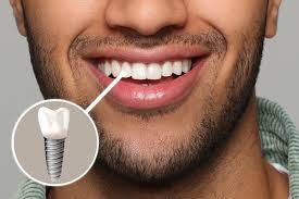 Image result for dental implant