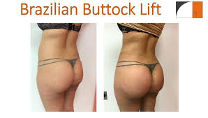 Count to ten before placing it back on the floor. Droopy Buttocks Surgery Tavallali Plastic Surgery