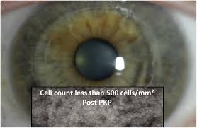 Potential Contraindications To Scleral Lens Wear Contact Lens And Anterior Eye