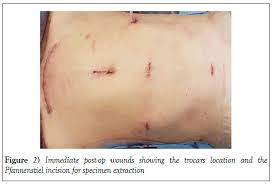 We did not find results for: A Case Report Of Laparoscopic Right Trisectionectomy With Caudate Lobe Resection