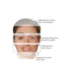 Bell's palsy and strokes are two medical conditions that start in the brain. Bell S Palsy Symptoms Diagnosis Treatment