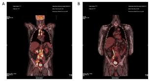 Look pictures & photos & images of cutaneous lymphoma. Non Hodgkin Lymphoma The Bmj