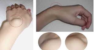 Voici Un Remede Naturel Efficace Pour Traiter Les Lipomes Regime Psoriasis Remedes Naturels Faits Maison Remedes Naturels