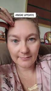 Angie Peacock Psych Injury