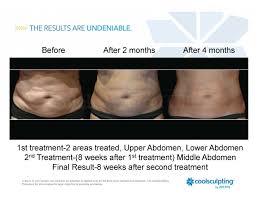 Is Coolsculpting For You Schedule A Consult Today To Learn More 253 838 8733 Cool Sculpting Coolsculpting Before And After Liposuction