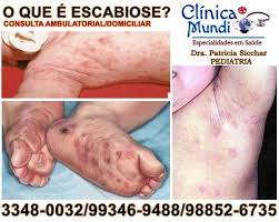 Hominis conhecida como sarna, e pediculose parasita pediculus humanus var. Clinica Mundi O Que E Escabiose A Escabiose Tambem Conhecida Como Sarna E Uma Doenca De Pele Causada Por Um Parasita Essa Doenca Que E Bastante Contagiosa E Caracterizada Principalmente