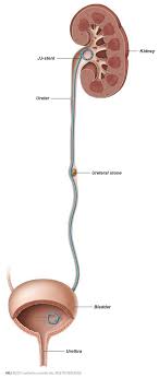 Percutaneous Nephrolithotomy Pcnl Patient Information