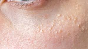 Primary milia often occur around the eyelids, cheeks, and forehead. How To Get Rid Of Milia Causes Prevention And Removal
